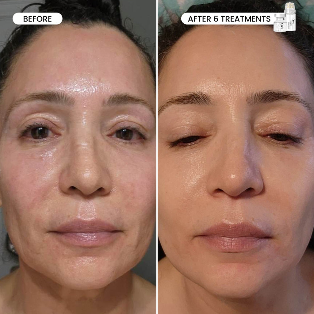 Micro-Infusion 2 Month Bundle (For Dark Spots)