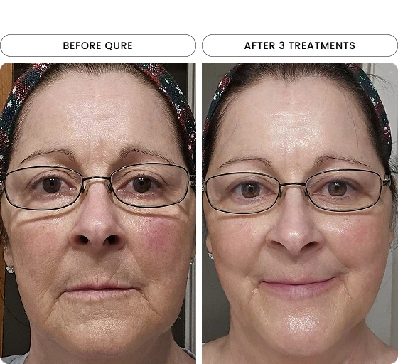 Micro-Infusion 6 Month (For Wrinkles + Dark Spots) UK