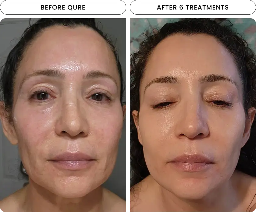 Micro-Infusion 6 Month (For Wrinkles + Dark Spots) UK