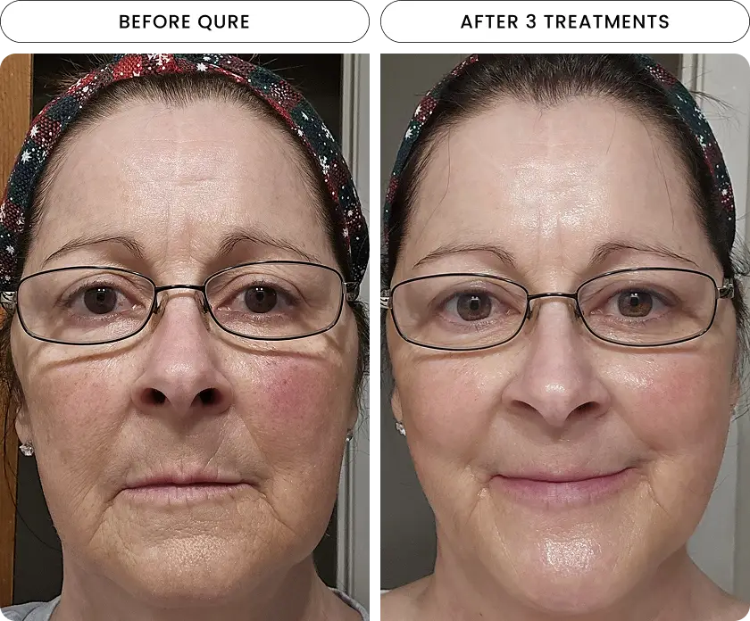 Micro-Infusion 6 Month Bundle (For Dark Spots)